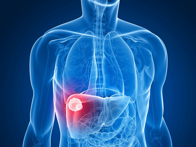 Ung thư gan: Gan nhiễm mỡ là bước nền âm thầm lớn nhất cho việc ung thư gan phát triển, ung thư gan hình thành do việc phát triển của bệnh lý xơ gan do thoái hóa mỡ